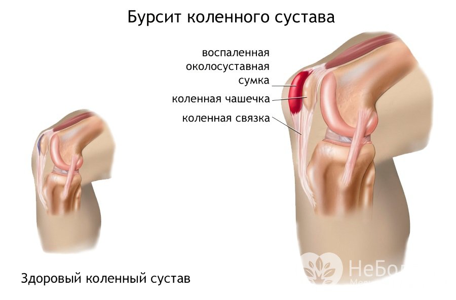 Артроз коленного сустава боли в мышцах Артроз коленного сустава боли в мышцах