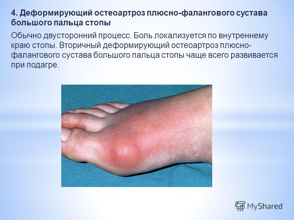 Артроз фаланги стопы Артроз фаланги стопы