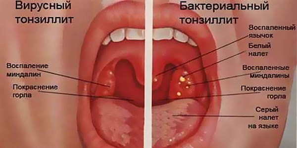 Лечение тонзиллита хронический в домашних условиях Лечение тонзиллита хронический в домашних условиях