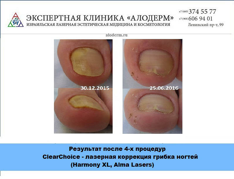 Где удаляют больные ногти Где удаляют больные ногти