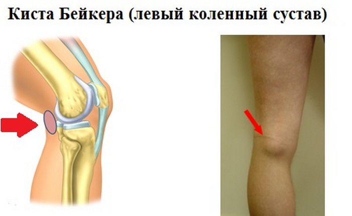 Позвоночник жировик Позвоночник жировик