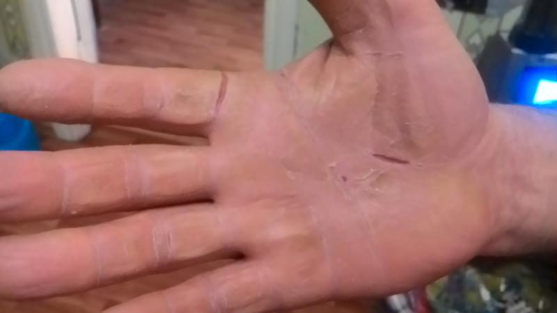 Трескается кожа на пальцах от чего лечение Трескается кожа на пальцах от чего лечение