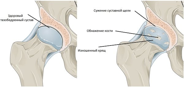 Как лечить тазобедренный сустав народная медицина Как лечить тазобедренный сустав народная медицина