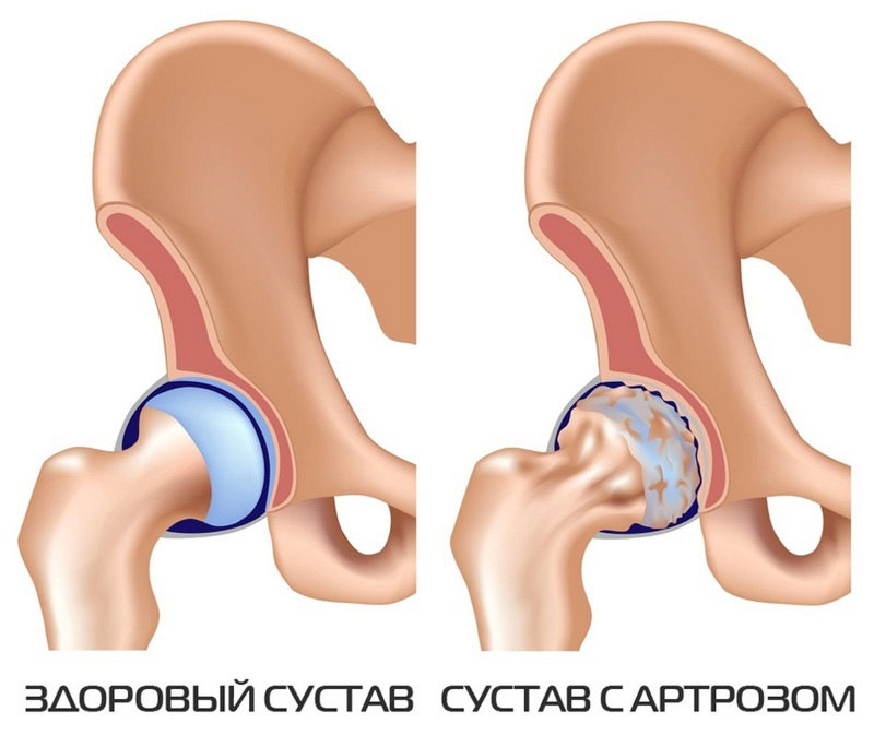 Что такое артроз суставов 2-3 степени Что такое артроз суставов 2-3 степени