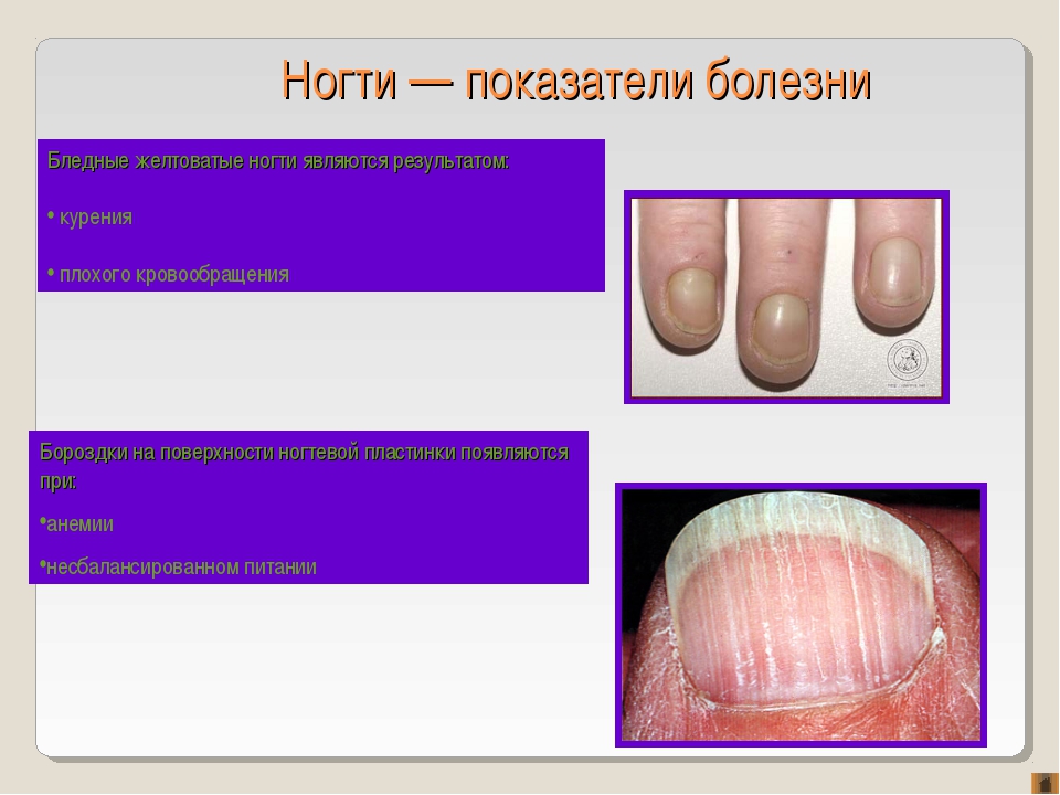 Лечение вросшего ногтя народными средствами ЗАПИСКИ Лена Ленина радикально сменила имидж