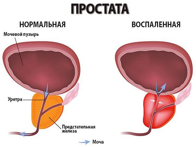 Массаж простаты дома мужу для кайфа пальцем и прибором: как Кровь в моче у мужчин: причины, симптомы, лечение