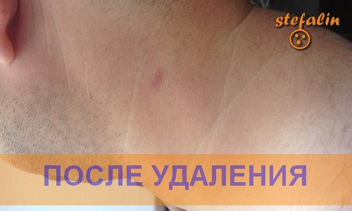 Кому удаляли бородавки лазарем Кому удаляли бородавки лазарем