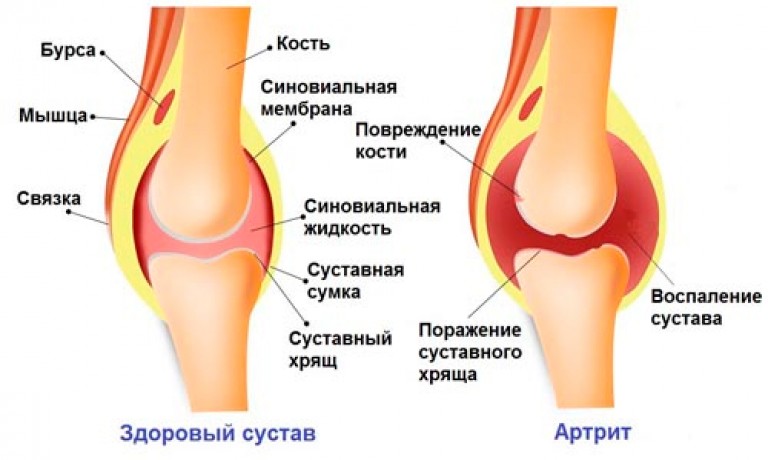 Как эффективно лечить артрит коленного сустава Как эффективно лечить артрит коленного сустава