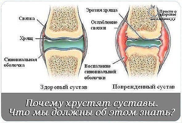 Почему щелкают суставы в коленях Почему щелкают суставы в коленях