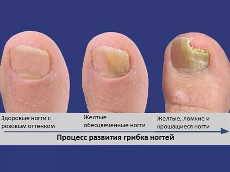 Грибок ногтей на ногах стадии как лечат Грибок ногтей на ногах стадии как лечат