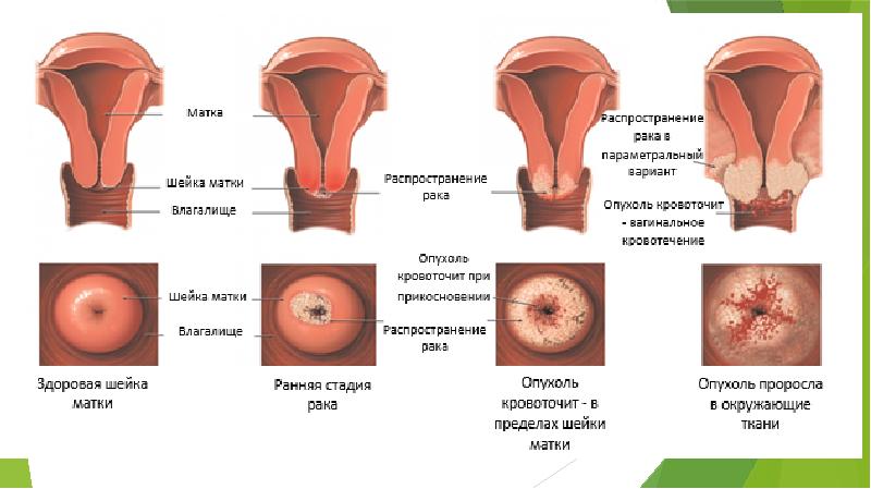 Рак шейки матки гинекология