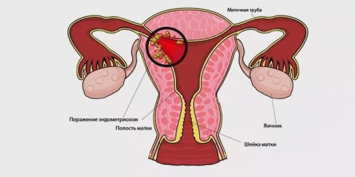 Женские болезни гинекология эндометриоз