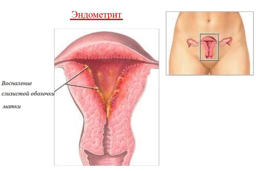 Женские простуды по гинекологии