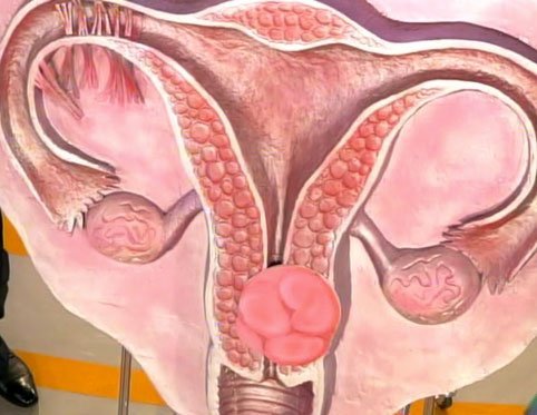 Вирус папилломы человека у женщин причины возникновения в гинекологии