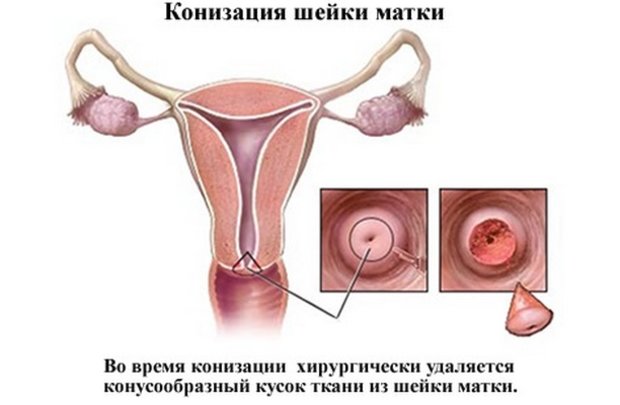 Впч что это такое у женщин в гинекологии